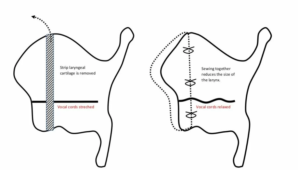 Can You Reverse Voice Deepening?